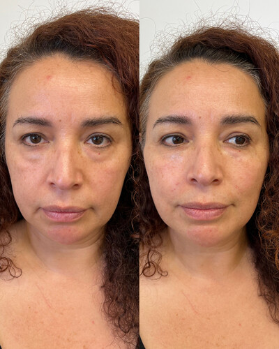 Undereye Filler
