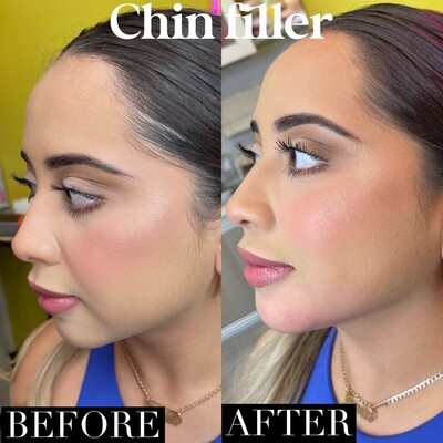 Chin 