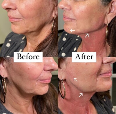 Jawline Lift