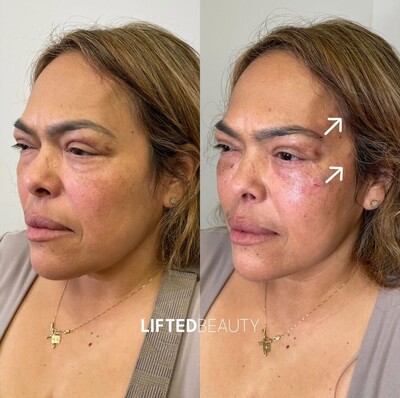 Brow Lift