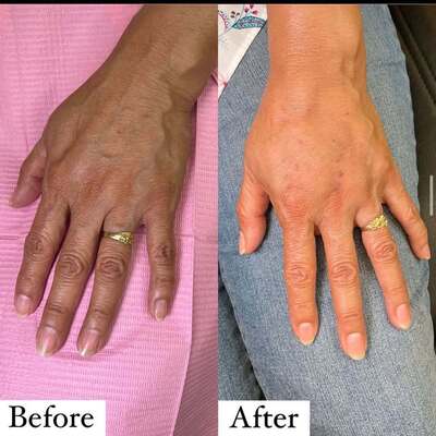 Hand Filler