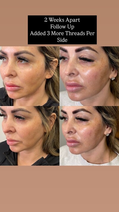 Upper and Mid Face Thread Lift