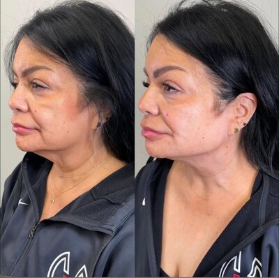 Neck Lift