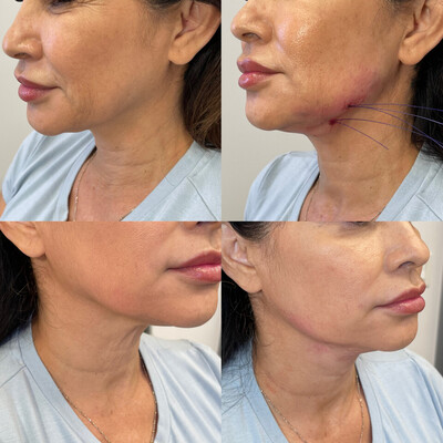 Neck Lift Only 